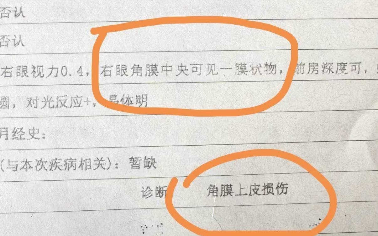 美睫需謹慎！網友嫁接睫毛后角膜上皮受損，醫生提醒愛美女性們避開這些坑